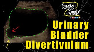 Urinary Bladder Diverticulum  Ultrasound  Case 273 [upl. by Buckley]