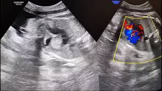 Intracardiac Tumor in fetus during pregnancy 37 weeks Rhabdomyoma [upl. by Tarttan]