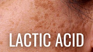 WHY Lactic Acid is Best For Hyperpigmentation [upl. by Ruford]