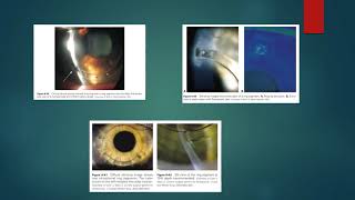 Crosslinking y anillos intraestromales [upl. by Anneuq980]