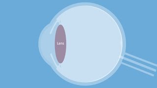 Wat is Staar cataract  oorzaak en vervolgstappen [upl. by Pogah]