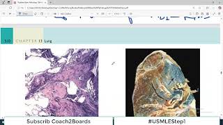 Chp13 Robbins Patho  Lung Pathology  Coal Worker Pneumoconiosis  Restrictive Lung Disorders [upl. by Willie]