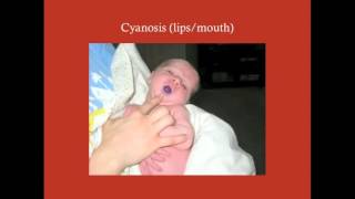 Surgery of Cyanotic CHDs  CRASH Medical Review Series [upl. by Nashner]