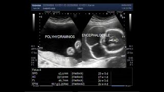 Ultrasound Video showing Fetus with Polyhydromnios and Encephalocele [upl. by Nyrmak]