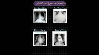 RADIOLOGICAL SIGNS IN CARDIOLOGY Mnemonic [upl. by Latreese]