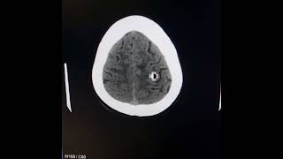 Normal pressure hydrocephalus Reduced callosal angle [upl. by Aiet440]