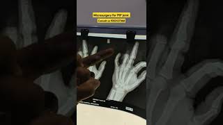 Fused PIP joint pain physiotherapy joints finger thumb operationsresearch anatomy ruhs mnd [upl. by Narmis]