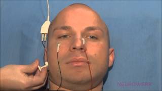 Motoric Neurography  Facial Nerve [upl. by Atiekal]