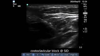 Costoclavicular block  13 sept 24 [upl. by Enella]