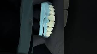 Crowns lithium disillicate ceramotion lisi incisal cut back layered with porcelain ceramotion Zr [upl. by Rieger]