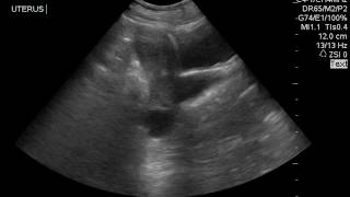 AIUM Case Challenge 46 Transabdominal ultrasound [upl. by Just336]