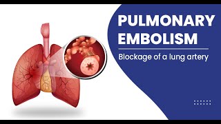 Pulmonary Embolism  Etiology Pathophysiology Clinical Features Diagnosis Treatment [upl. by Verras]