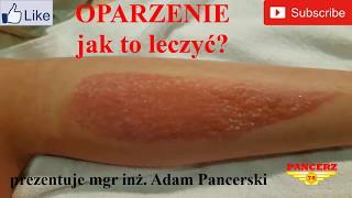 OPARZENIE jak leczyć Oparzenie co robić Oparzenia słoneczne leczenie [upl. by Sampson734]