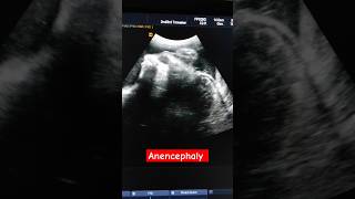 Anencephaly with brain dangling behind in the amniotic fluid anomalyscan [upl. by Neenahs]