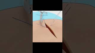 Sutures and Suturing techniques surgeryshortsanatomy [upl. by Benzel]