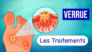 Verrues  Les Traitements pour les Soigner [upl. by Eivets702]