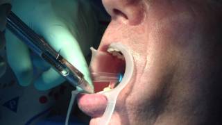 Root canal treatment and tooth damaged repair PART 1 [upl. by Eugenie172]