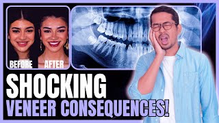 Why You Should Never Get Veneers – A Cautionary Tale [upl. by Iffar364]