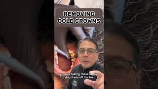 How to Remove GOLD Crowns WITHOUT Destroying It  In Office to Hands On Dental Training shorts [upl. by Anyt]