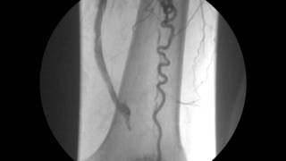 ANGIOPLASTIA CON STENT DE ARTERIA FEMORAL PROFUNDA 3 [upl. by Anemix32]