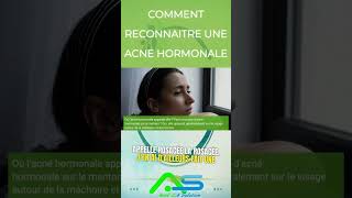 comment reconnaitre une acne hormonale [upl. by Azila]