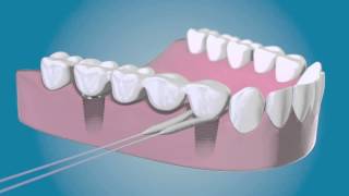 TePe Bridge amp Implant Floss  für die Reinigung um die Implantate [upl. by Runstadler]