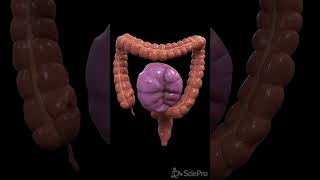 Understanding Colon Volvulus A Twist in the Digestive Tale [upl. by Torbart]