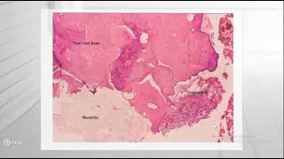 Osteomyelitis Part 2 [upl. by Atteynot]