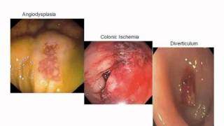 Persistent Lower GI Bleeding  R Coimbra MD [upl. by Ehtylb828]