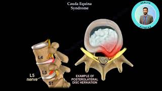 Cauda Equina Syndrom [upl. by Latsirk]