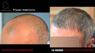 FUE 3090 Ufs MeDiKemos Hair Transplantation ESP [upl. by Willmert446]