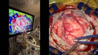 Awake craniotomy Resection of tumor invading center of Compassion and Kindness with compassion [upl. by Rolf]