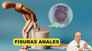 Las Fisuras Anales  Todo lo que querías saber [upl. by Illib]