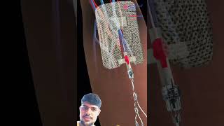 IV insertionIntravenous Catheter medicalanimation 3d4medical [upl. by Desireah]