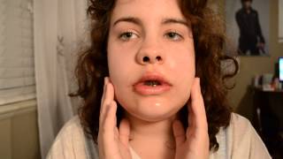 Day two after Double Jaw Surgery  Genioplasty [upl. by Esinyt]