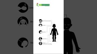 Epilepsy treatment at Life Homeopathy Clinic [upl. by Krahling131]