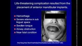 Complications in anterior implants [upl. by Assirk]