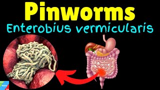 Pinworms Threadworms Symptoms Causes Treatments Life Cycle – Enterobius vermicularis [upl. by Yblok]