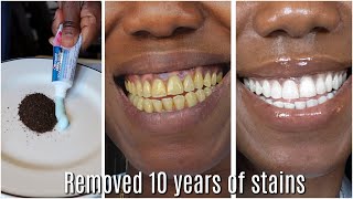 in two minutes remove 10 years of stains from teeth Results will Shock You [upl. by Barmen]