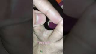 Tinea pedis itching and cracked skin in between toes [upl. by Reddin]