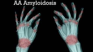 quotWhat Is AA Amyloidosis Diseasequot [upl. by Llegna]