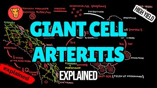 Giant cell artheritis Pathogenesis EULAR Diagnostic criteria Treatment of Temporal arteritis [upl. by Eniamrahc779]