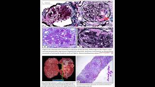 Diabetic Nephropathy part 2✅ kidney MORPHOLOGYRobbins 10th ed renalpath12 [upl. by Nrubliw987]