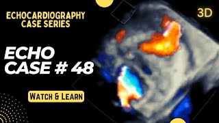 Echocardiography Case 48 Echo Spot Diagnosis Series  Learn Cardiology [upl. by Jenette]