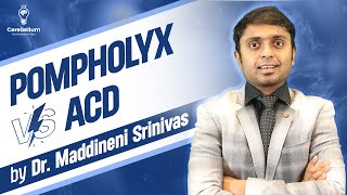 Pompholyx Vs ACD by Dr Maddineni Srinivas  Cerebellum Academy [upl. by Akel]