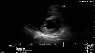 Chapter 7  Hyperdynamic left ventricle PSAX view [upl. by Vin837]