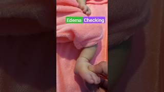 How to Check Edema  Checking pedal edema  Causes of edema  Nephrotic syndrome  Kwashiokar  CCF [upl. by Arlo]