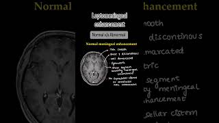 Leptomeningeal enhancement Full video on our channelXrayusg mri brain neuroimaging neetpg [upl. by Pirali]