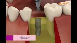 OSSTEM IMPLANT TSIII System Surgical Procedure Taper Kit and Straight Drill Kit [upl. by Gnaig]