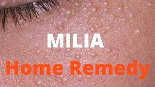 Milia treatment [upl. by Yatnuahc222]